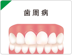 西宮市武庫川(むこがわ)鳴尾、小松北町にある歯医者 まつうら歯科クリニックの歯周病