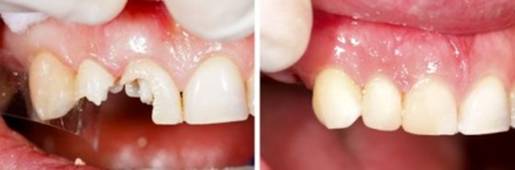 乳歯のむし歯治療