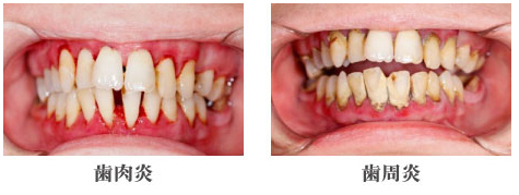 歯肉炎と歯周病の画像